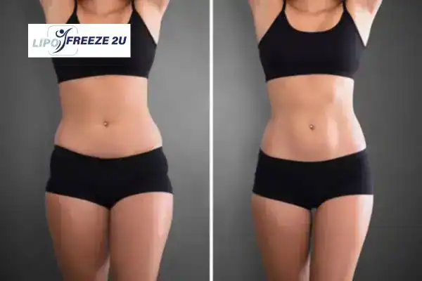 How Can LIPO FREEZE 2U Support Your Post-Pregnancy Body Recovery ?