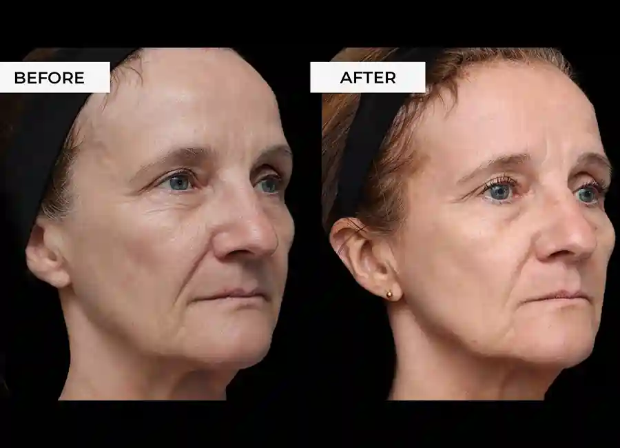How Many RF Microneedling Sessions Will You Need to See a Difference ?