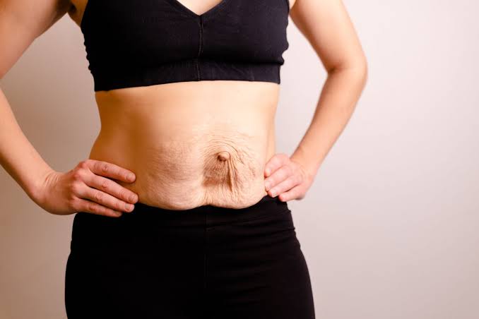 Is Surgery Really the Only Way to Repair Diastasis Recti ?