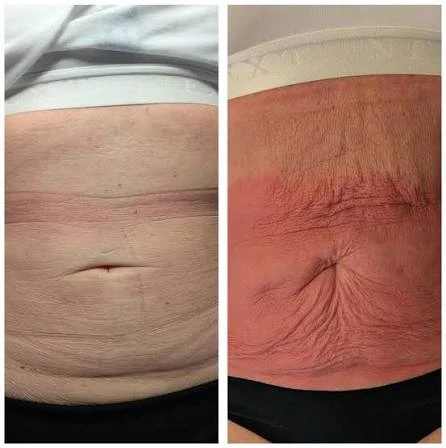 How Does RF Microneedling Improve Crepey, Thin and Uneven Skin Texture ?