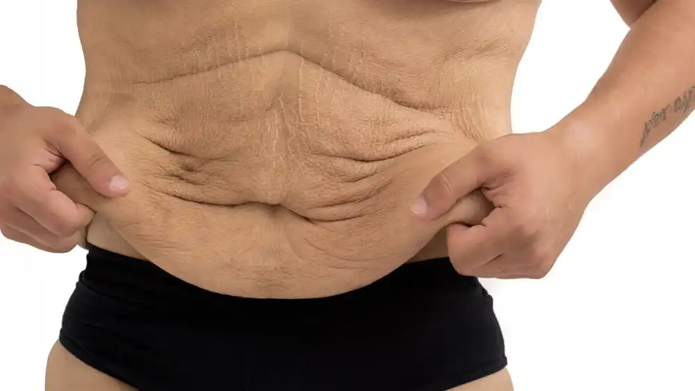 Why Does Weight Loss Medication Leave Some People With Loose or Sagging Skin ?